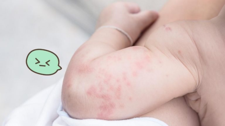 Dermatitis Atopik Adalah Penyakit Abadi Bataviase Co Id