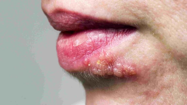 bumps-on-lips